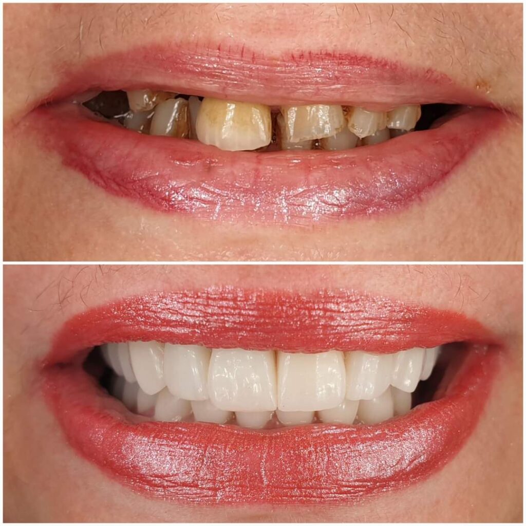 coroana dentara laborator tehnica dentara atlantis virtual lab