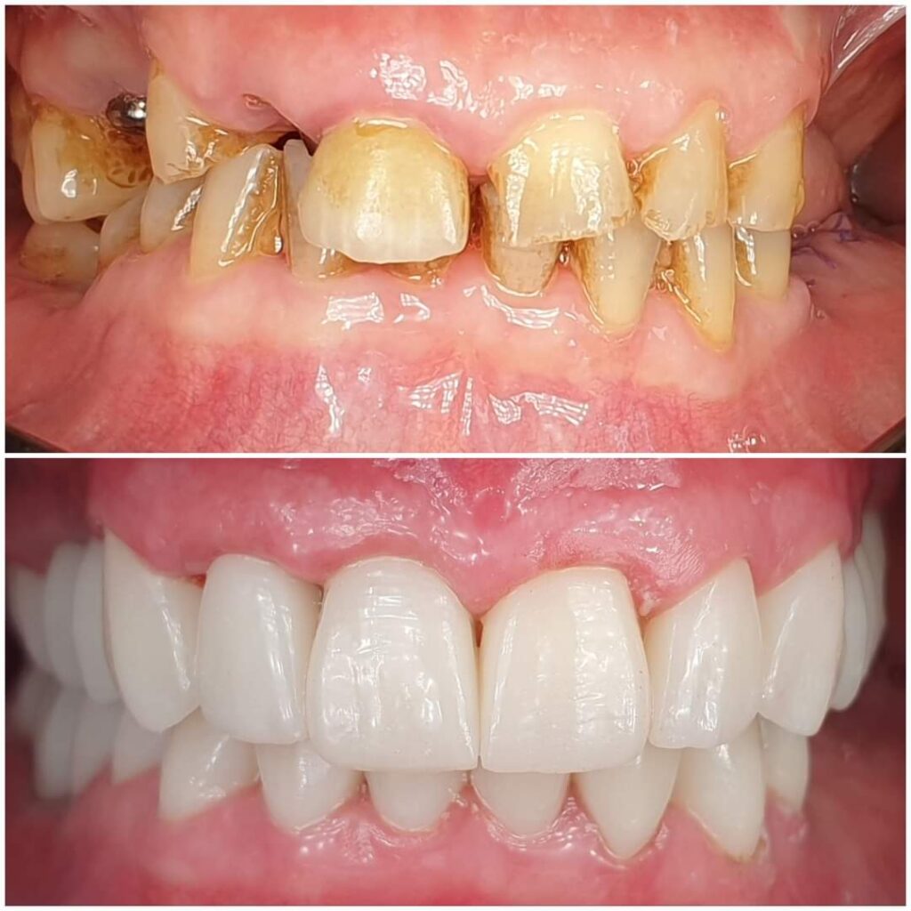 coroana laborator tehnica dentara atlantis virtual lab