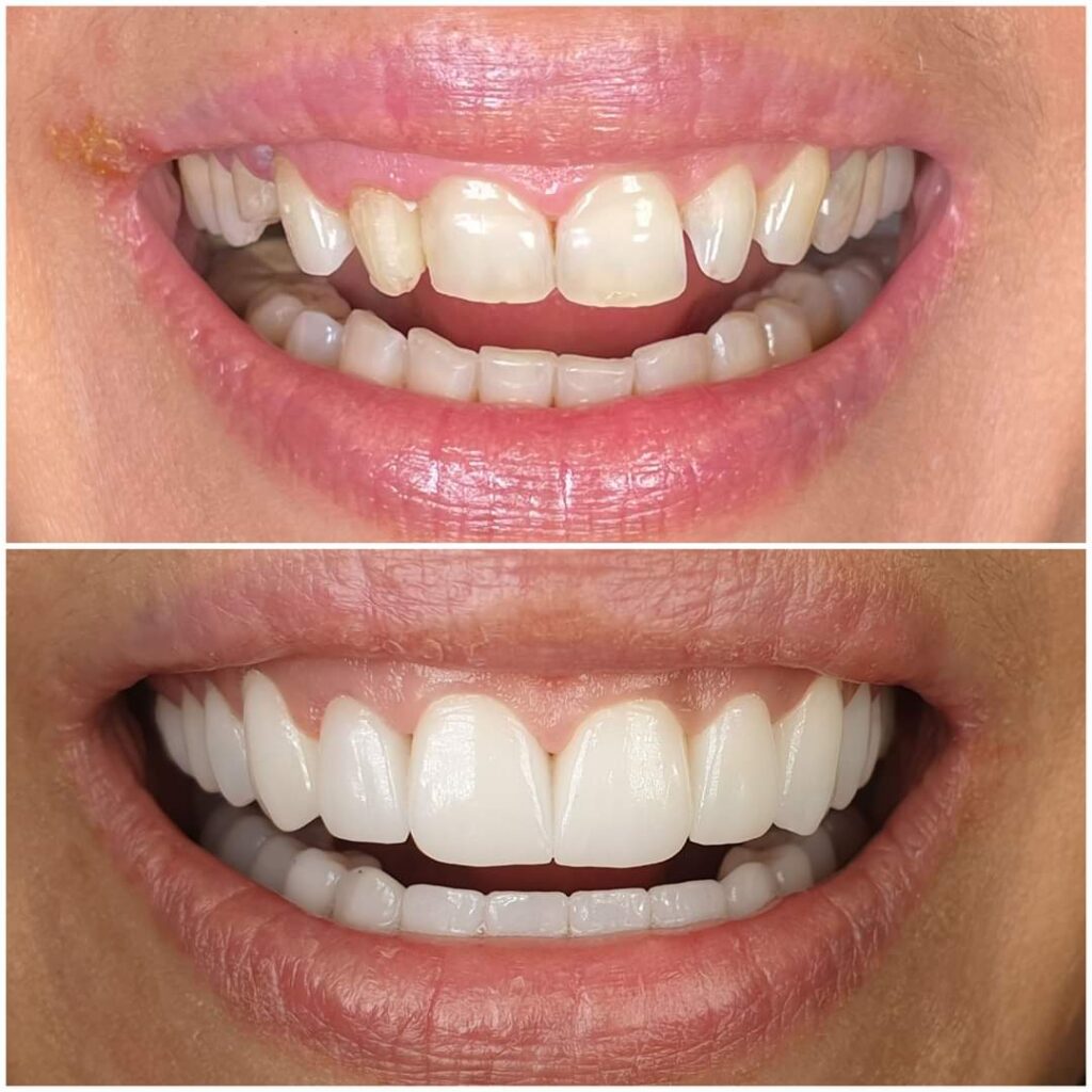 coroana laborator tehnica dentara atlantis virtual lab