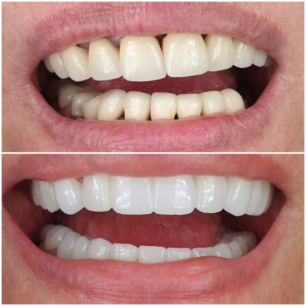 coroana laborator tehnica dentara