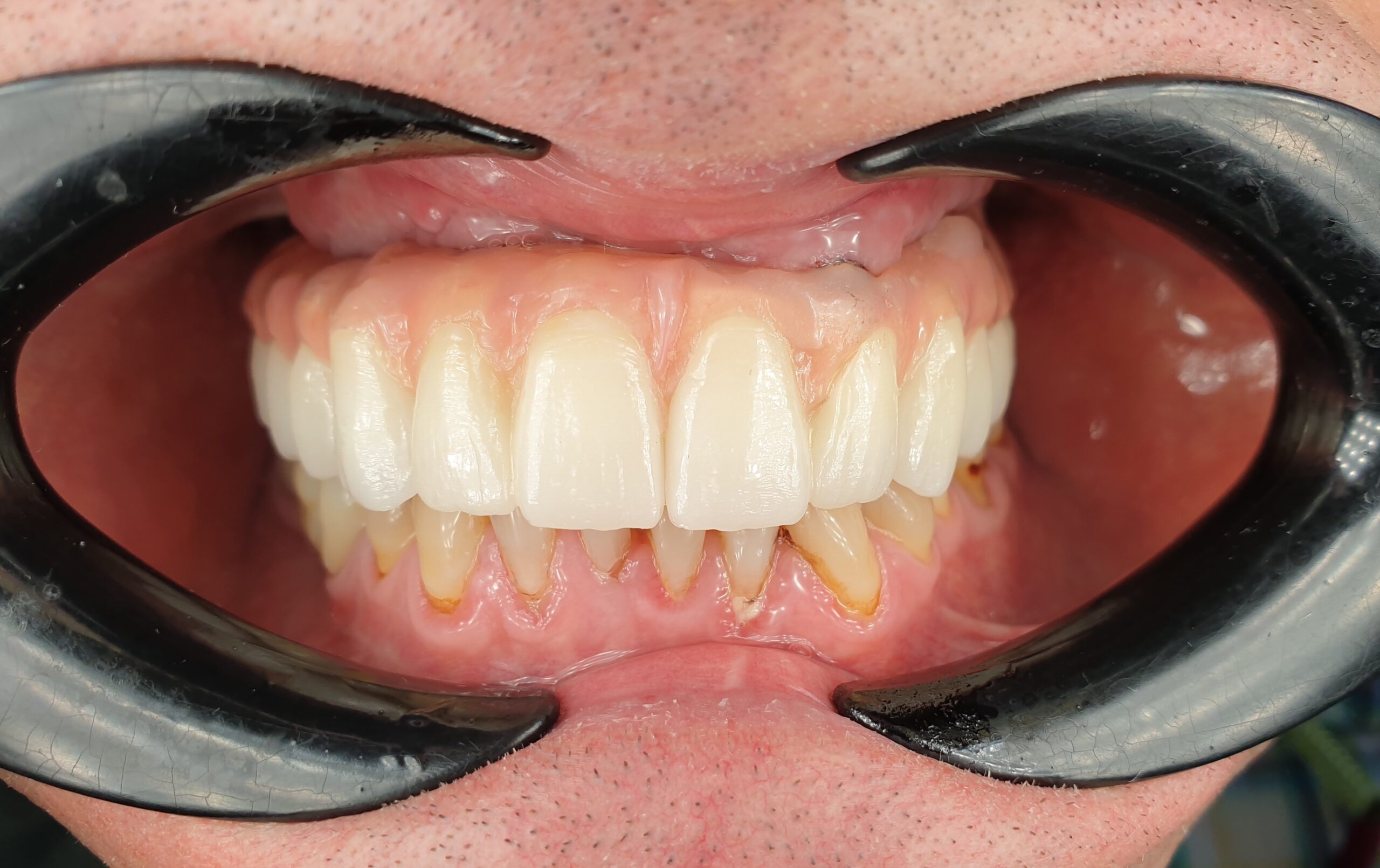 coroana dentara avl32