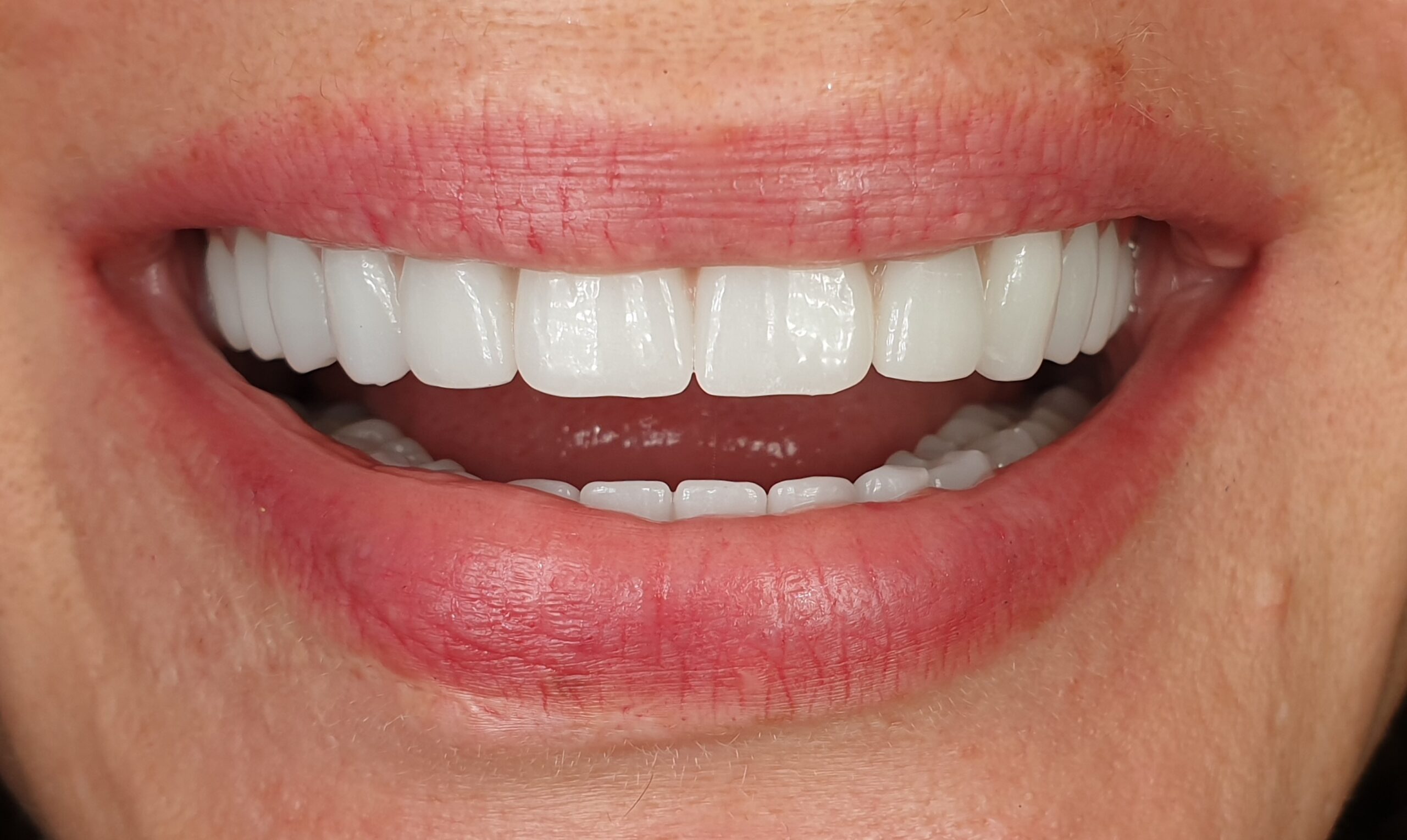 all on x titan si zirconiu avl32