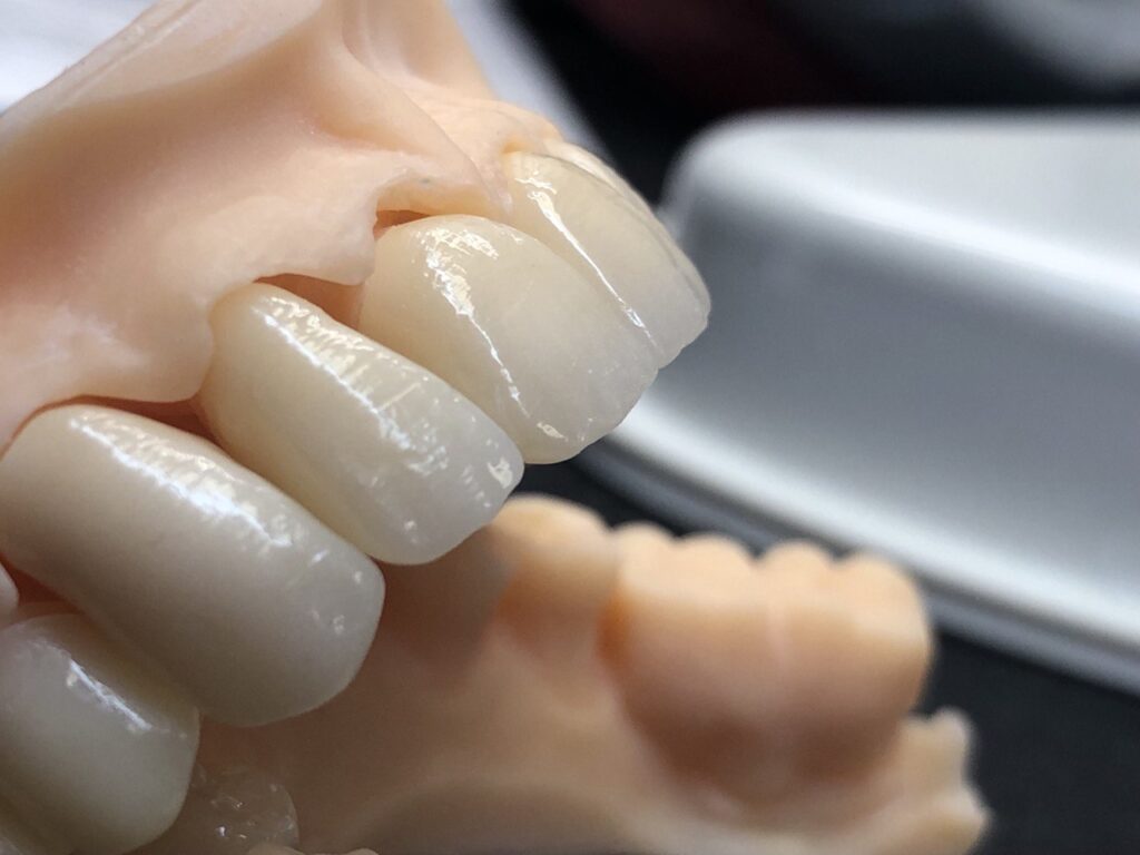 Coroane Zirconiu Estetic