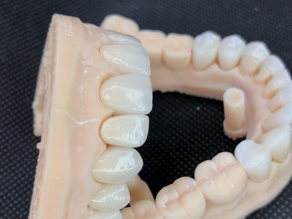 Coroane si fatete estetic avl32
