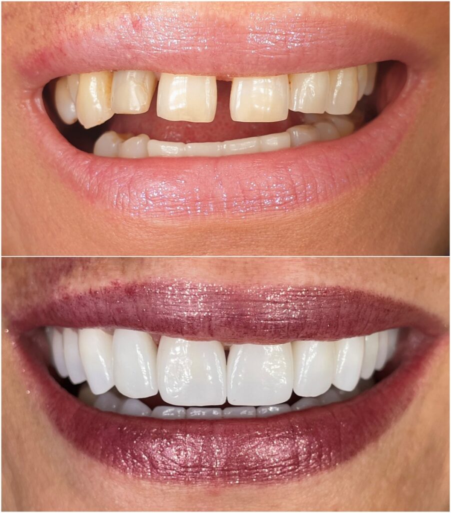 Coroane si fatete zirconiu